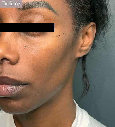 cheek filler before